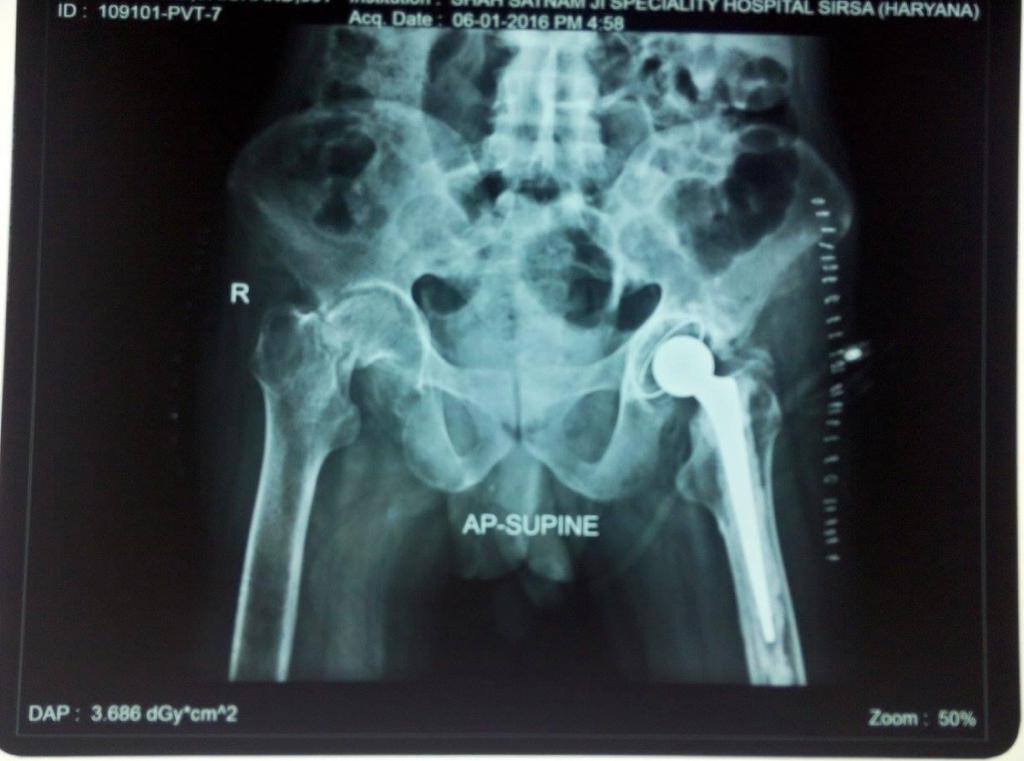 HIP/KNEE REPLACEMENT