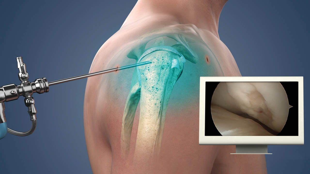 SHOULDER ARTHROSCOPY